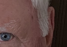 Grahame Pilgrim's melanoma story