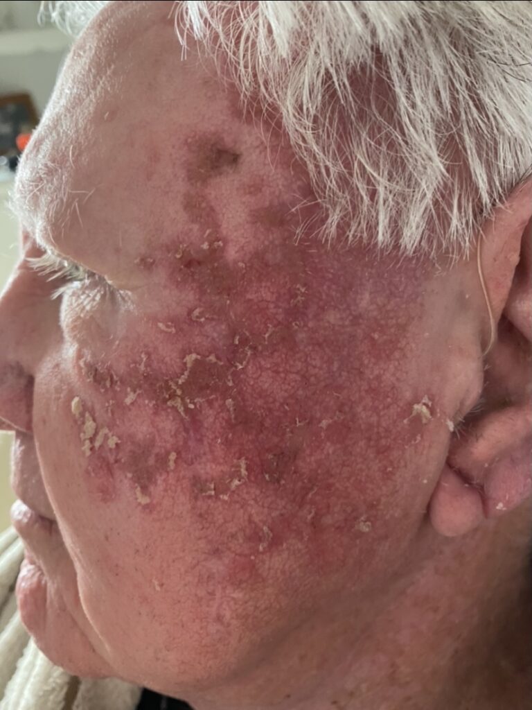 Grahame Pilgrim's melanoma story